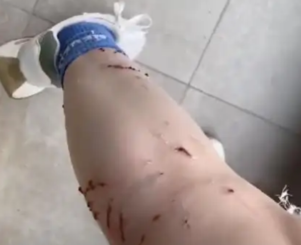 女子遭宠物猫咬伤致腿部溃烂，千元疫苗接种费用支出